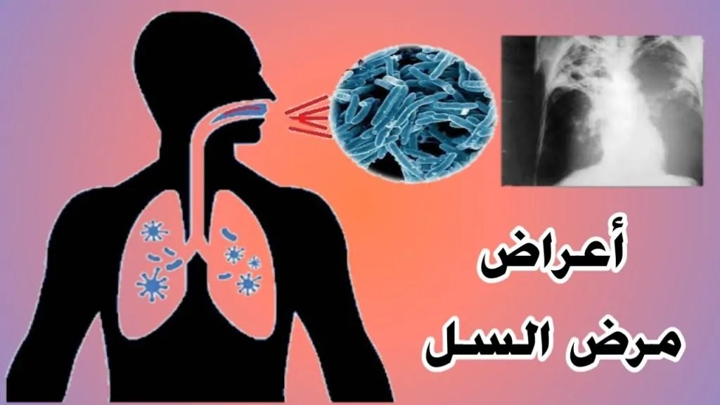 7 معلومات عن مرض السل عقب ظهوره في الولايات المتحدة الأمريكية 2 مرض السل