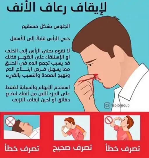 تعرف على أسباب نزيف الأنف والأشخاص الأكثر عرضة له 3 نزيف الأنف