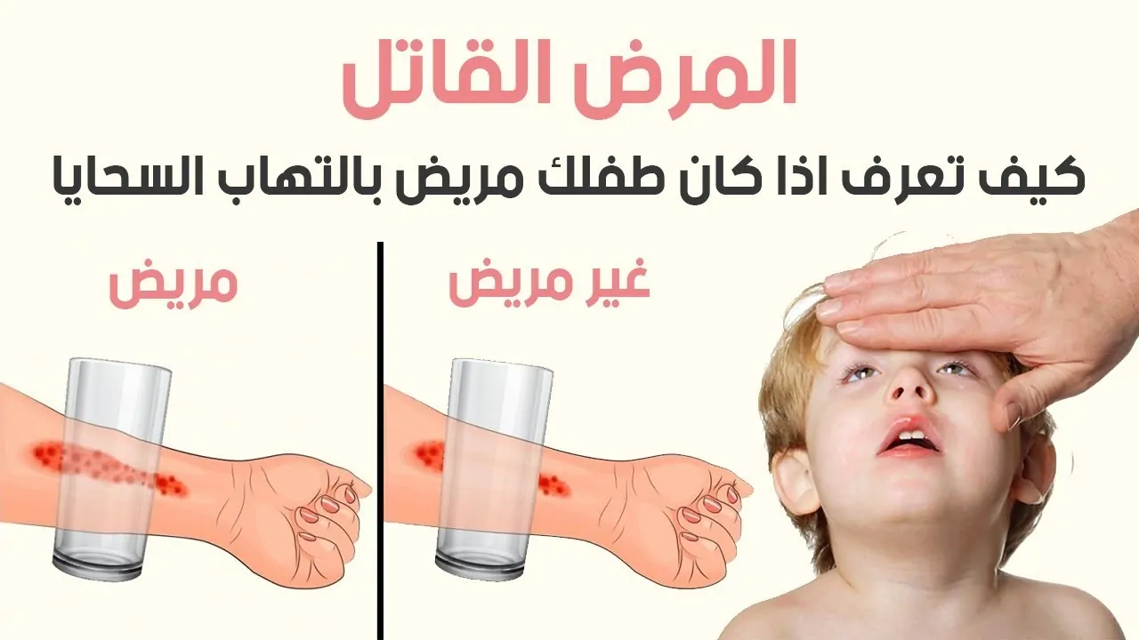 معلومات عن الالتهاب السحائي بعد وفاة 4 أشقاء بالمنيا 3 الالتهاب السحائي