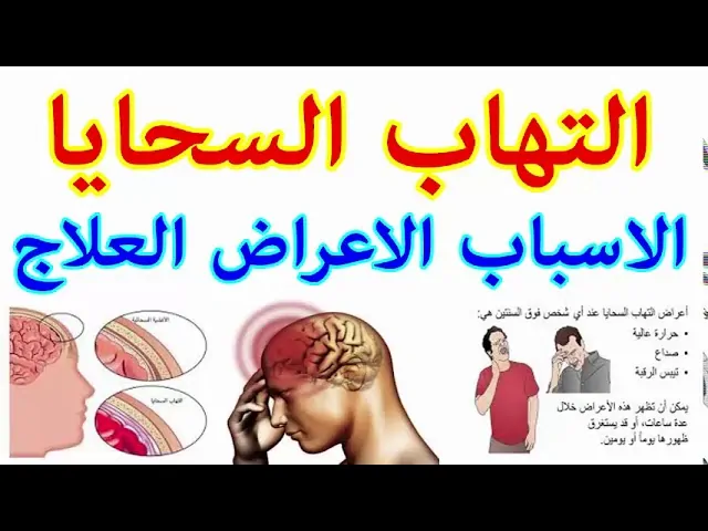 معلومات عن الالتهاب السحائي بعد وفاة 4 أشقاء بالمنيا 4 الالتهاب السحائي