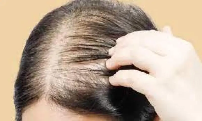 طريقة علاج الصلع