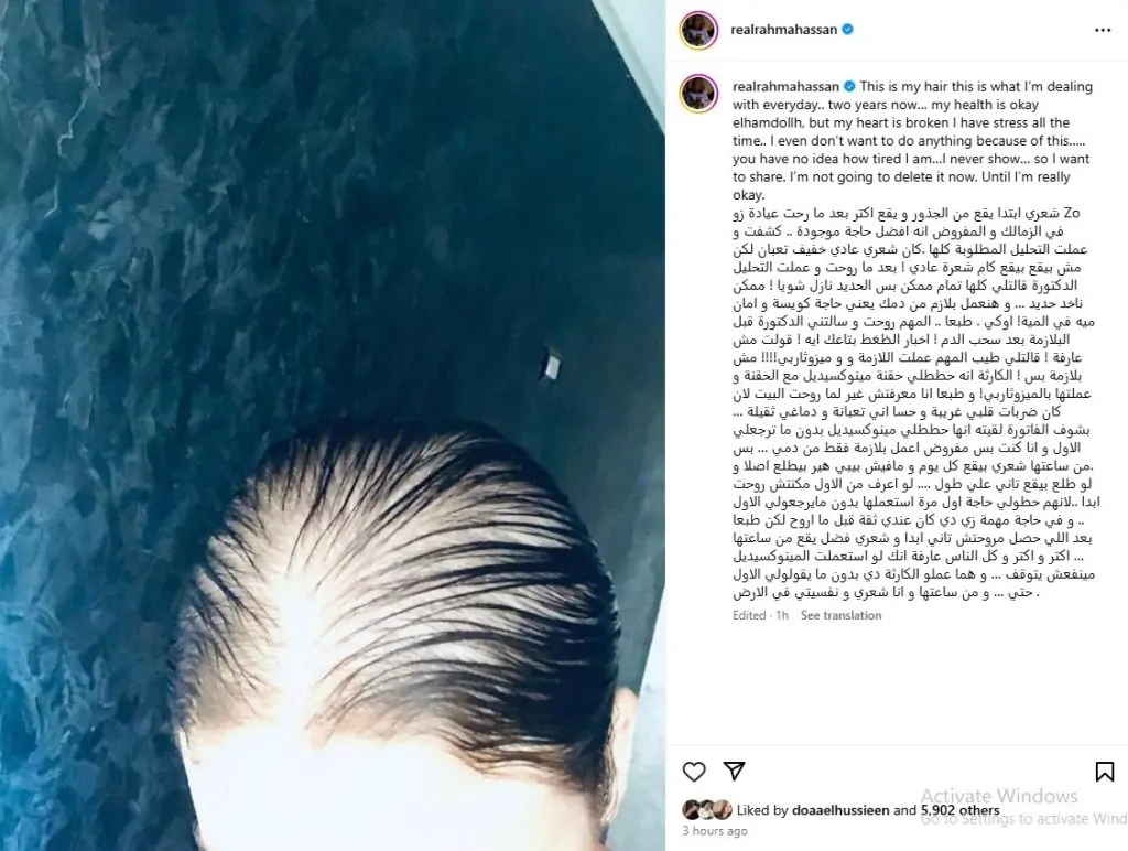 الفنانة رحمة حسن تعلن إصابتها بالصلع