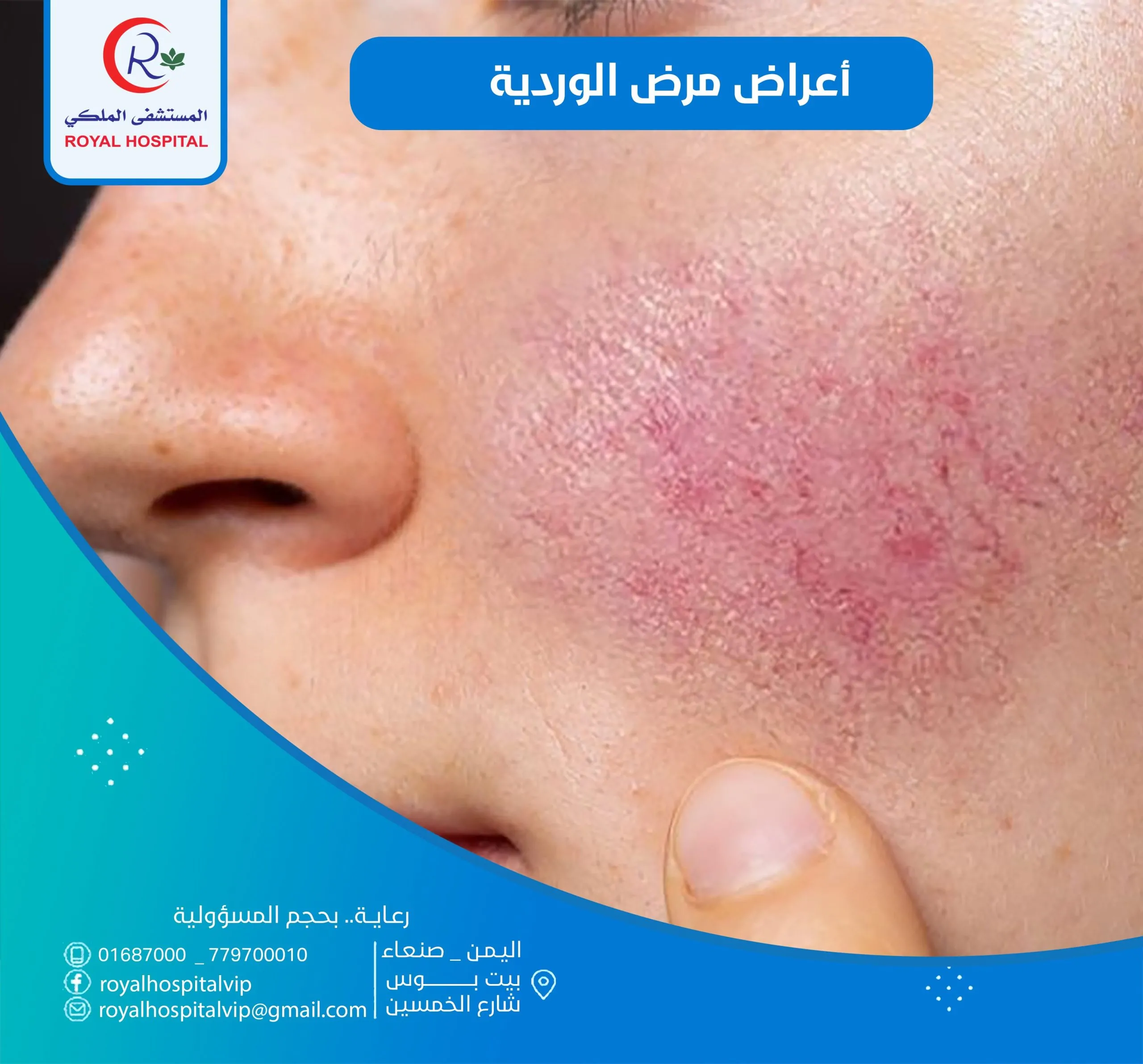 مرض الوردية كل ما تريد معرفته عن أعراضه وطرق علاجه 4 مرض الوردية