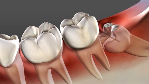 لماذا يسبب «ضرس العقل» الصداع المزمن؟.. تعرف على الأسباب وطرق الوقاية