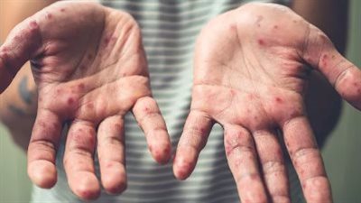 المتحدث باسم وزارة الصحة والسكان يكشف تفاصيل انتشار HFMD في مدرسة بالجيزة