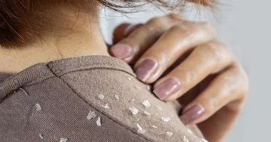 أسرار قشرة الرأس: تعرف على الأسباب الجذرية وعلاجاتها الفعالة