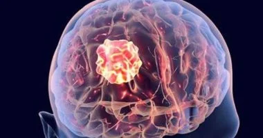 الورم الحميد: متى يصبح خطراً ويستدعي التدخل الجراحي؟