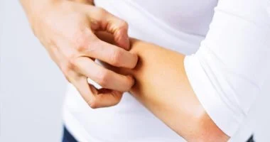 الوقاية من لدغات الناموس وعلاجها طبيعيًا في الصيف