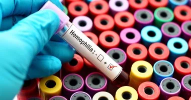 اليوم العالمي للهيموفيليا: أعراض تنذرك بضرورة العناية الفورية