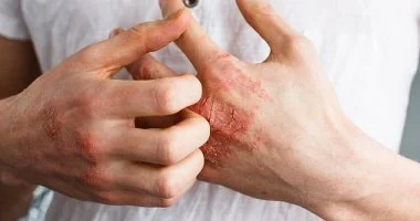 دراسة تربط الإكزيما باضطرابات النوم والذاكرة: 8 نصائح للتحكم