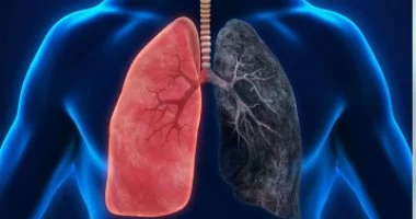 ذكاء اصطناعي جديد يتنبأ باستجابة سرطان الرئة للعلاج مبكراً