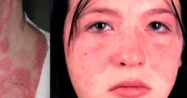 مرض الذئبة الحمراء: الأسباب والأعراض وطرق السيطرة عليه