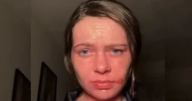 مرض مناعي نادر يحول الشمس لعدو.. بريطانية تصاب بحروق خلال 15 ثانية