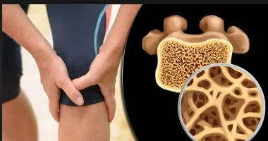 مركبات طبيعية ثورية لزراعة عظام أقوى تقاوم العدوى والسرطان