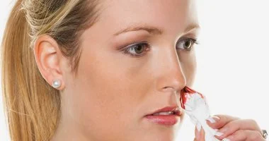 نزيف الأنف المتكرر: هل ضغط دمك المرتفع هو السبب الخفي