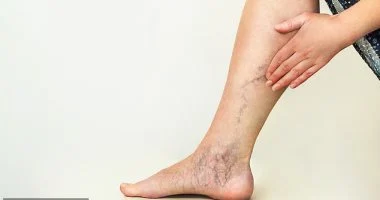 الجلوس لفترات طويلة أيضا قد يسبب دوالى الساقين.. طرق الوقاية