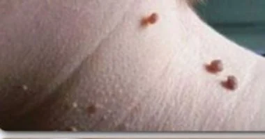 الزوائد الجلدية الصغيرة.. متى تصبح إزالتها أمر ضرورى؟