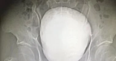 جراحة نادرة تنهى معاناة مزارع صينى مع حصوة ضخمة فى المثانة