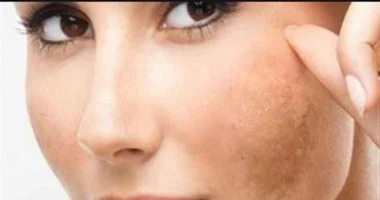 جفاف البشرة وهشاشة الأظافر.. أسباب كامنة وراء هذه الحالة وطرق فعالة للعلاج
