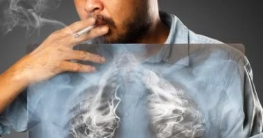 خبراء: فحص للبول يمكنه التنبؤ بسرطان الرئة خلال 5 سنوات