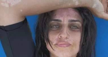 أمير كرارة يدعم شقيقته..لماذا يعد الدعم النفسى أساسيا فى رحلة مريض البهاق