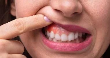 الميكروبات قد تسبب الإصابة بنوع فرعى من سرطان الفم