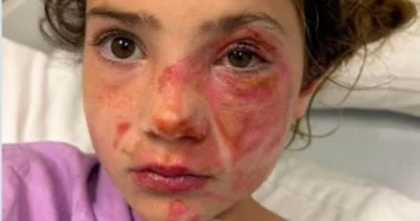 تحذيرات فى بريطانيا من لعبة مطاطية تسببت فى حروق بالغة للأطفال