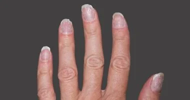 طرق سهلة لعلاج أظافرك المتشققة.. وطرق سهلة للوقاية