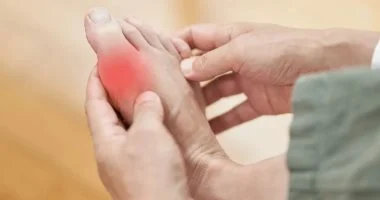 مرضى النقرس.. طرق صحية لتناول اللحوم دون نوبات ألم